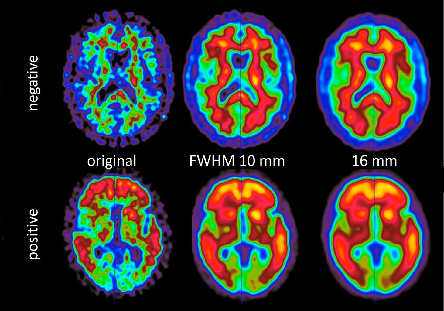 PET image of brains without (top) and with (bottom) amyloid deposits. The deposits can be recognized by the red colouring, even with reduced spatial resolution (centre and right). PET image of brains without (top) and with (bottom) amyloid deposits. The deposits can be recognized by the red colouring, even with reduced spatial resolution (centre and right).