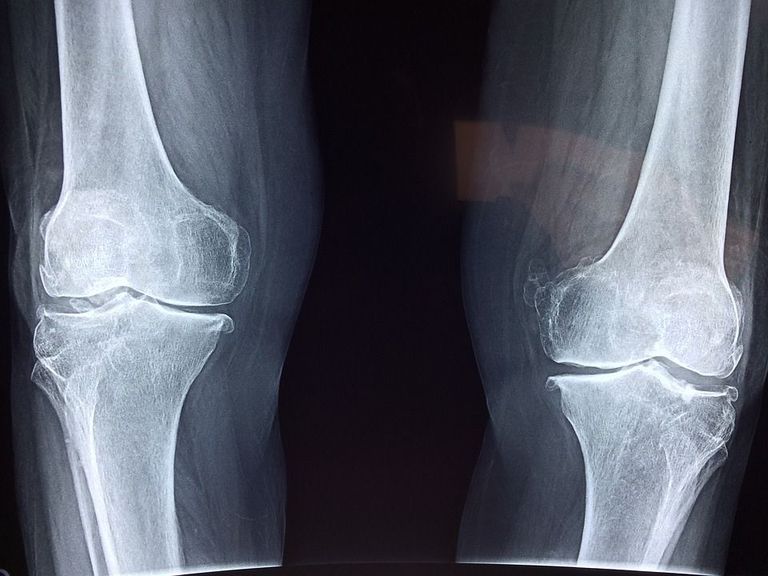 X-ray of lower limbs